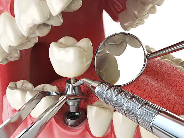 Best Emergency Tooth Extraction in Salton City, CA